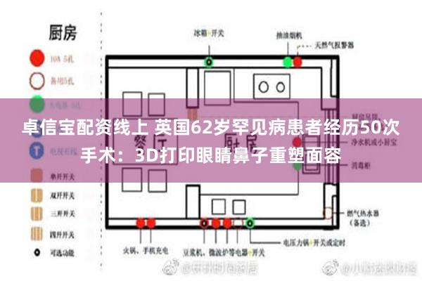 卓信宝配资线上 英国62岁罕见病患者经历50次手术：3D打印眼睛鼻子重塑面容